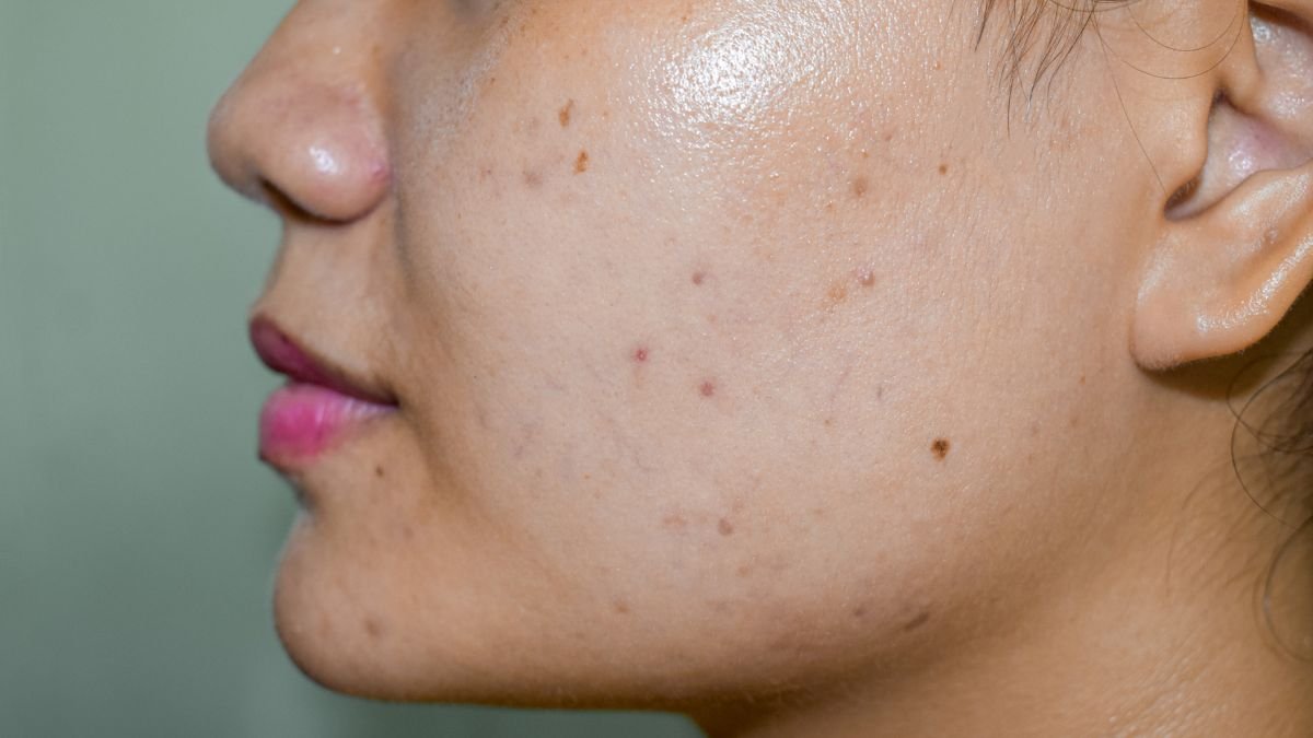 how-to-get-rid-of-brown-spots-on-skin