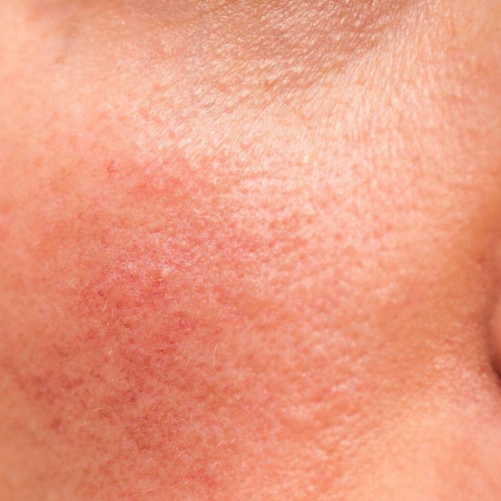 woman-with-rosacea-on-side-on-face