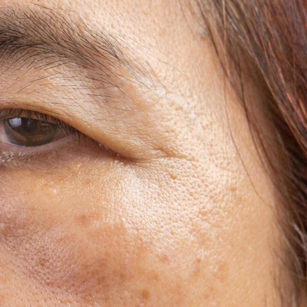 brown-age-spots-on-skin-on-the-side-of-the-face